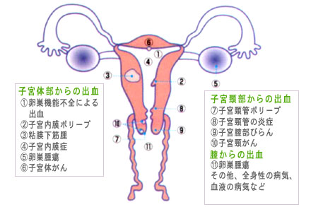 頚 管 ポリープ 子宮 子宮頸がんと子宮頸管ポリープの関係！原因や悪性である確率も！